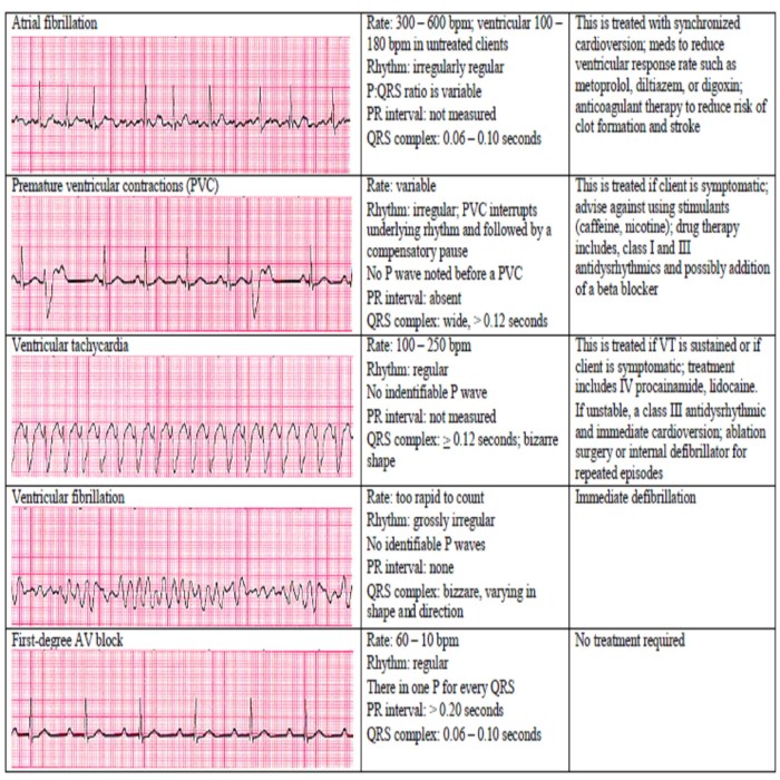 Basic dysrhythmia review for the nurse adventhealth