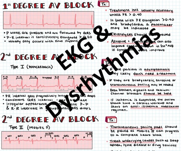 Cardiac rhythm dysrhythmias nurse rhythms ekg ecg interpretation nclex