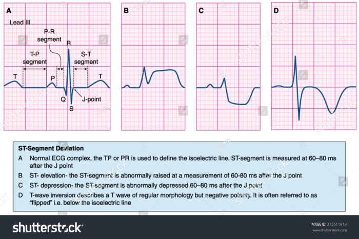 Basic dysrhythmia review for the nurse adventhealth